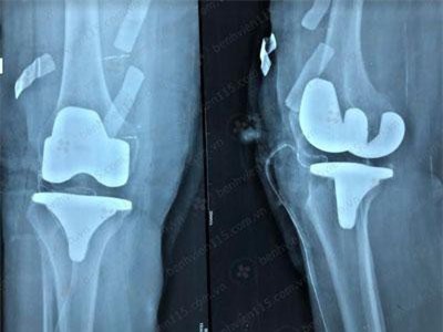 Phẫu thuật thay khớp gối, khớp háng miễn phí tại TP.HCM