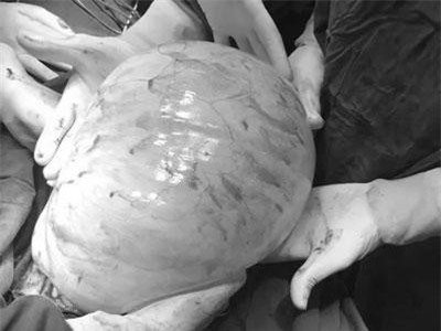 Đốt ngải chữa bệnh, bụng cô gái trẻ to vuợt mặt như mang thai 9 tháng