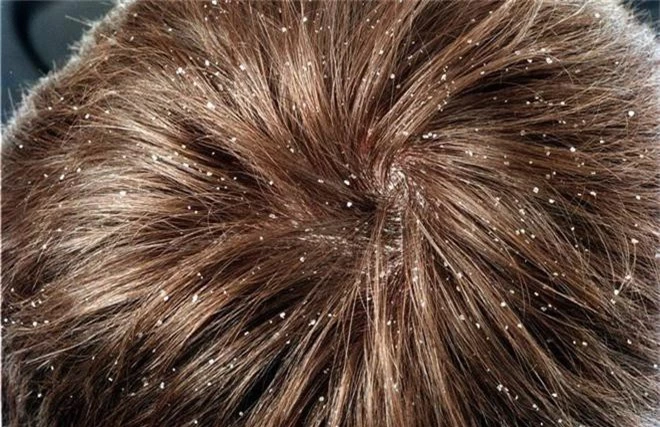Một vài dấu hiệu khác thường ở mái tóc đang ngầm báo hiệu nhiều vấn đề sức khỏe tiềm ẩn - Ảnh 1.