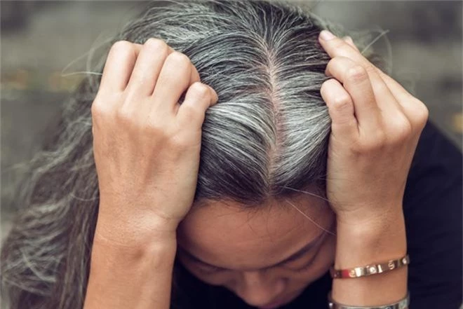 Một vài dấu hiệu khác thường ở mái tóc đang ngầm báo hiệu nhiều vấn đề sức khỏe tiềm ẩn - Ảnh 4.