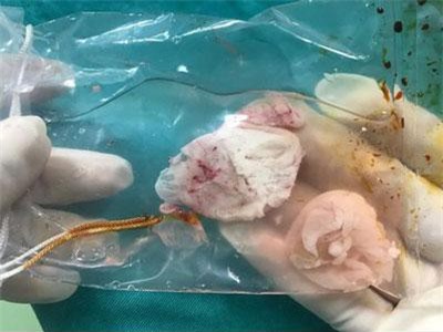 Hay ăn tiết canh, rau sống, người đàn ông có ổ sán não khổng lồ gây liệt nửa người