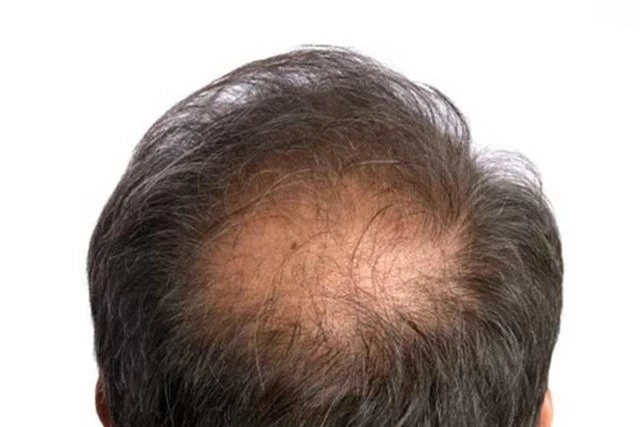 Nhận biết tình trạng sức khỏe của bạn qua mái tóc - Ảnh 8.