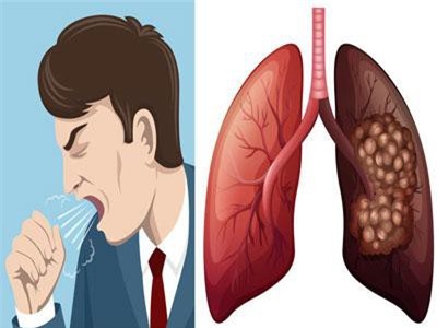 Những ai nên xét nghiệm tầm soát ung thư phổi?