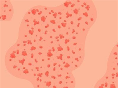 9 câu hỏi giúp 'giải mã' các phát ban trên da