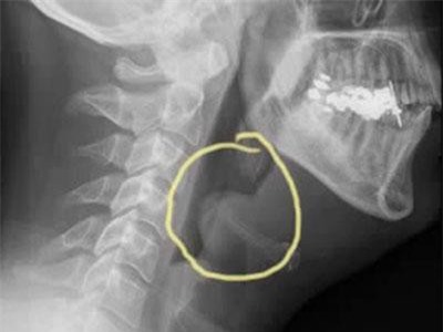 Đột ngột đau họng, khó nuốt - nói, khó thở: Coi chừng viêm thanh thiệt