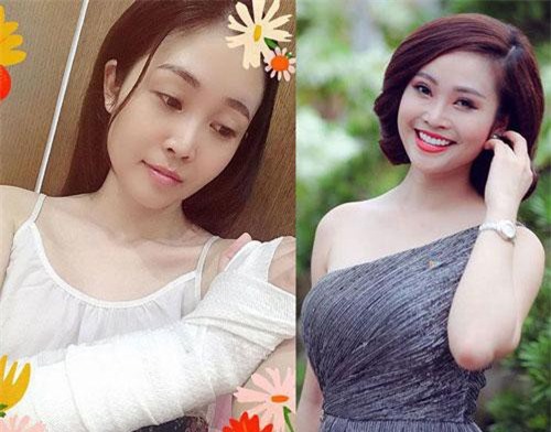 MC sở hữu "nụ cười đẹp nhất" VTV gặp tai nạn gãy tay