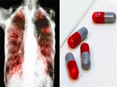 Lao là bệnh truyền nhiễm gây tử vong hàng đầu thế giới