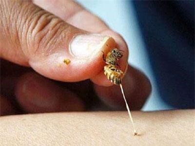 Suýt chết vì nhồi máu cơ tim cấp do một vết ong đốt