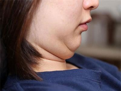 CLIP: Hướng dẫn cách giảm mỡ nọng cằm chỉ sau 1 tháng