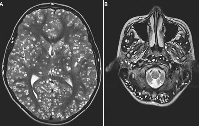 Ăn thịt lợn chưa nấu chín, nam thanh niên 18 tuổi tử vong vì nhiễm sán lợn trong não