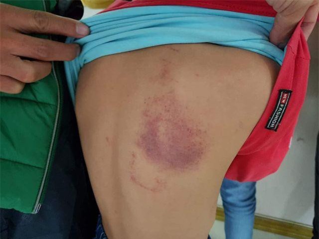 Vụ cô giáo dùng thước vụt học sinh lớp 2 bầm tím vai: Phạt 5 triệu đồng, đình chỉ công tác giảng dạy một tháng