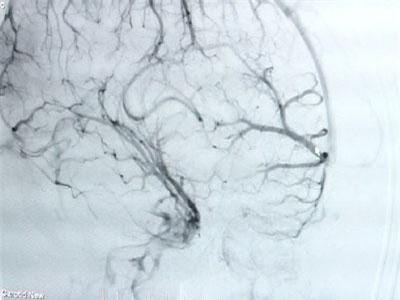 Bệnh nhân trẻ xuất huyết não sau nhiều áp lực công việc