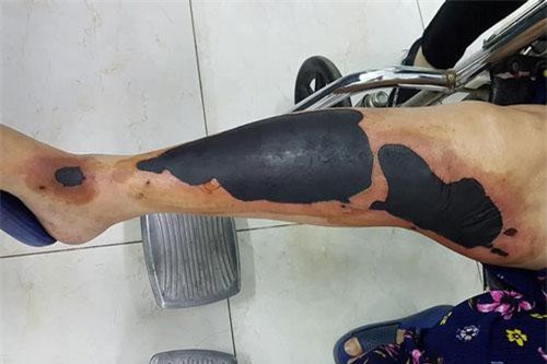 Đắp cao lá vối chữa bỏng, người phụ nữ ôm chân hoại tử cầu cứu bác sĩ