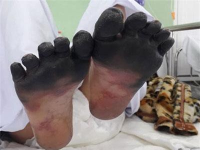 Các ngón chân, tay khô đen như phim “kinh dị”