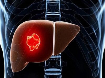 Ung thư gan: Thực trạng đáng báo động