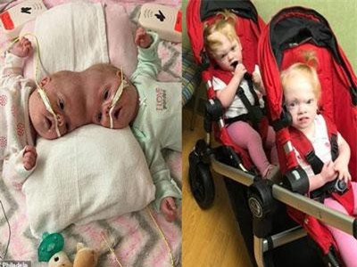 Bất ngờ với cuộc sống hiện tại của cặp song sinh dính liền đầu sau ca phẫu thuật tách rời cách đây 2 năm