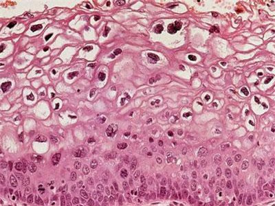 Vắc-xin HPV giúp giảm đáng kể nguy cơ ung thư cổ tử cung