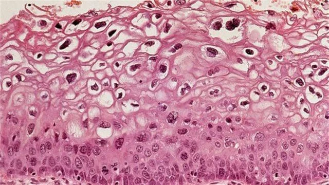 Vắc-xin HPV giúp giảm đáng kể nguy cơ ung thư cổ tử cung - 1