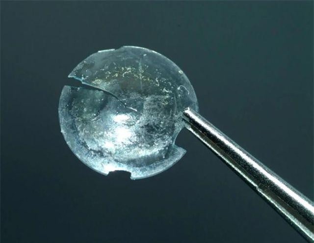 Người phụ nữ bị mắc kẹt kính áp tròng trong mí mắt 28 năm nhưng… không biết