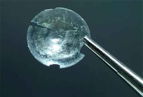 Người phụ nữ bị mắc kẹt kính áp tròng trong mí mắt 28 năm nhưng… không biết