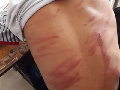 Hà Tĩnh: Học sinh lớp 8 đến lớp với nhiều vết thương, nghi bị bố đánh dã man