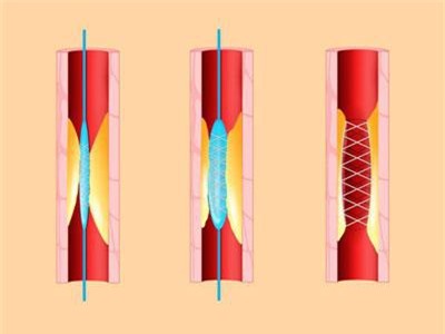 Stent tim: Đặt hay không đặt?