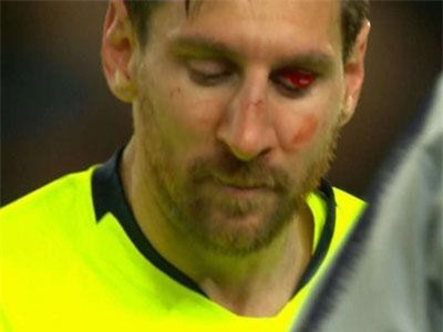 Messi có thể phải đeo mặt nạ đá trận lượt về với Man United