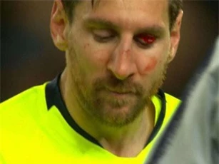 Messi có thể phải đeo mặt nạ đá trận lượt về với Man United