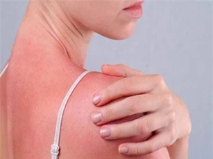 Ngộ độc ánh nắng mặt trời - tình trạng nguy hiểm cần được nhận biết ngay