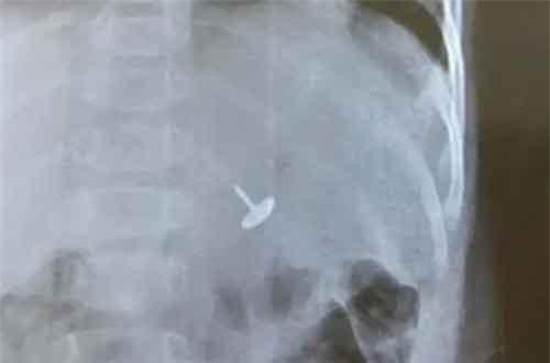 Đinh vít chui tọt vào dạ dày bé trai 11 tháng tuổi