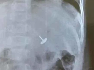 Đinh vít chui tọt vào dạ dày bé trai 11 tháng tuổi