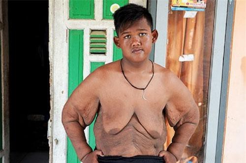 Cậu bé mập nhất thế giới giảm được 106kg