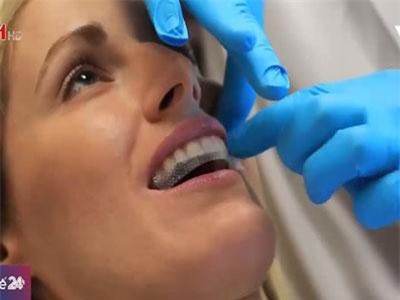 Miếng dán trắng răng có hại cho răng như thế nào?