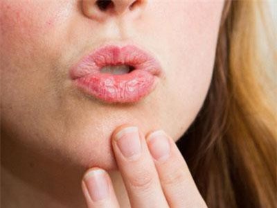 Bị ngứa rát ở viền môi: Tưởng bình thường nhưng hóa ra lại cảnh báo nhiều chứng bệnh