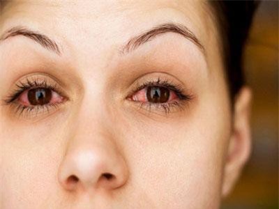 Đau mắt đỏ: Bệnh dễ gặp khi thời tiết sắp chuyển sang nóng bức