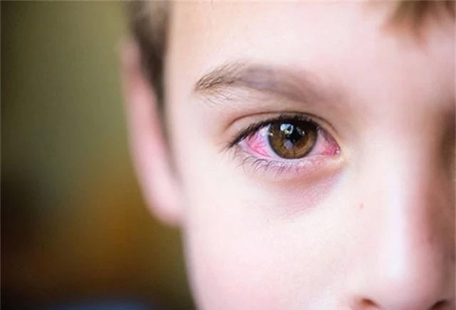 Đau mắt đỏ: Bệnh dễ gặp khi thời tiết sắp chuyển sang nóng bức - Ảnh 2.