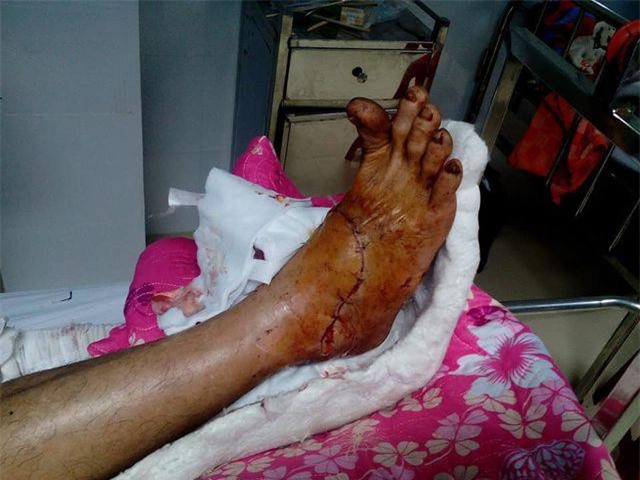 Quảng Nam: Nối thành công bàn chân bị máy cắt cỏ cứa gần như đứt lìa