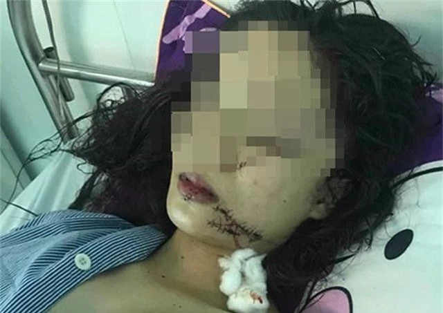 Thiếu nữ 18 tuổi bị 3 cô gái xông vào khống chế, dùng dao rạch mặt - 1
