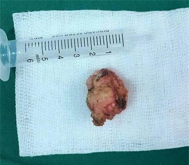 Bác sĩ “lôi” khối u xơ vú 2cm ra khỏi ngực bệnh nhân không để lại dấu vết sẹo - 1