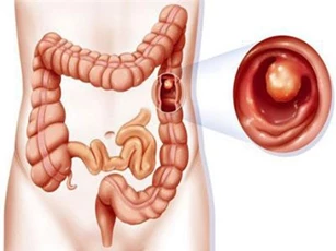 Trong 6 yếu tố làm tăng nguy cơ mắc ung thư đại trực tràng này thì có 2 điều là không thể tránh