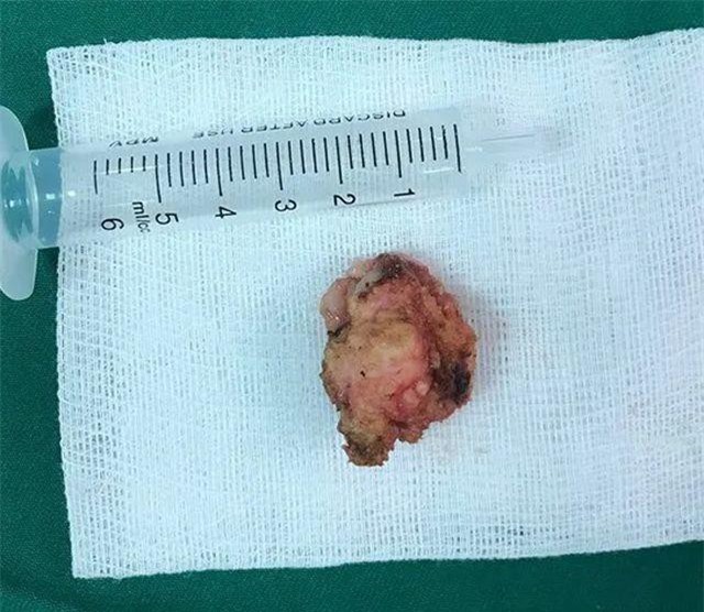 Bác sĩ “lôi” khối u xơ vú 2cm ra khỏi ngực bệnh nhân không để lại dấu vết sẹo