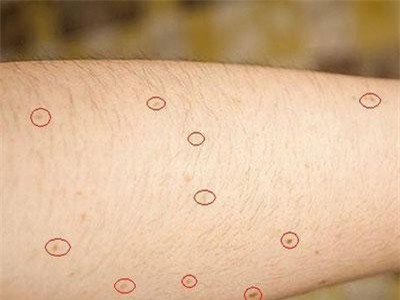 Nguy cơ mắc bệnh ung thư đang nhen nhóm trong cơ thể bạn nếu xuất hiện các triệu chứng sau