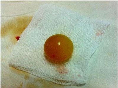 Nguy hiểm: Trẻ nuốt phải hạt nở