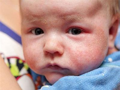 8 căn bệnh về da phổ biến trẻ sơ sinh nào cũng dễ mắc, các mẹ đang nuôi con nhỏ nên lưu ý
