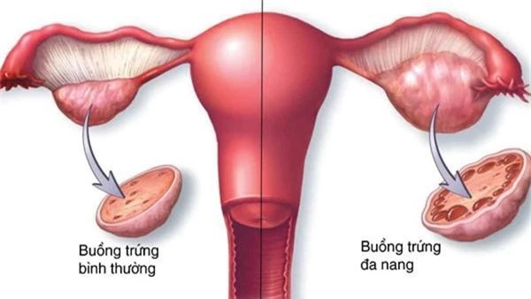 Ăn kiêng và tập thể dục có thể cải thiện hội chứng buồng trứng đa nang không? - Ảnh 3.