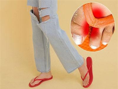 Nếu có thói quen lúc nào cũng đi dép xỏ ngón, bạn cần biết những tác hại không ngờ này để hạn chế