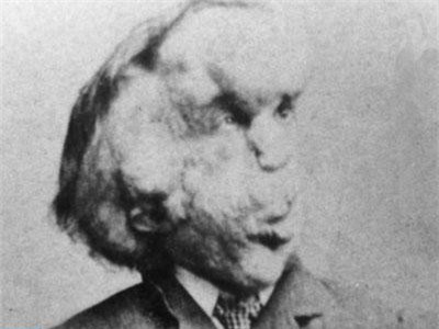 Hài cốt của "Người voi" bí ẩn có thể đã được phát hiện