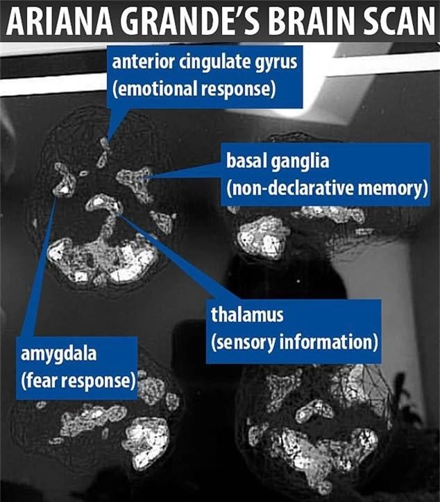 Nữ ca sĩ Ariana Grande chia sẻ bức ảnh đáng sợ về căn bệnh đã hủy hoại bộ não của cô - Ảnh 3.