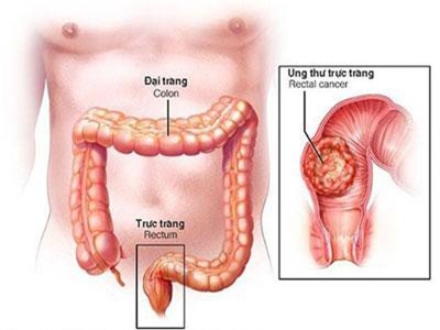 Đừng nhầm lẫn ung thư đại trực tràng với rối loạn tiêu hóa
