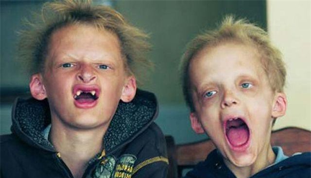 Top 10 căn bệnh kỳ lạ và đáng sợ nhất trên thế giới, y học chưa có lời giải